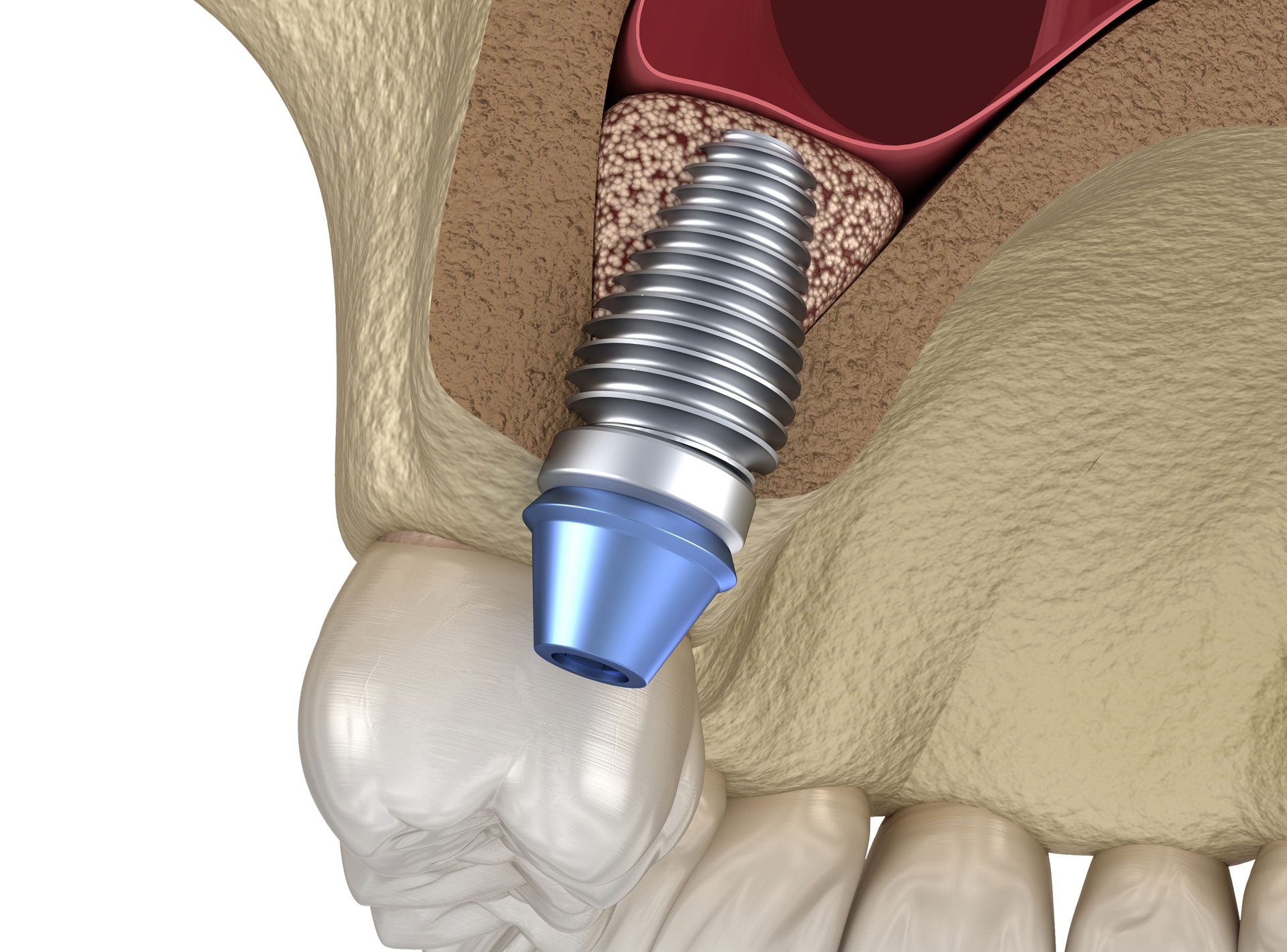 Dental Implants