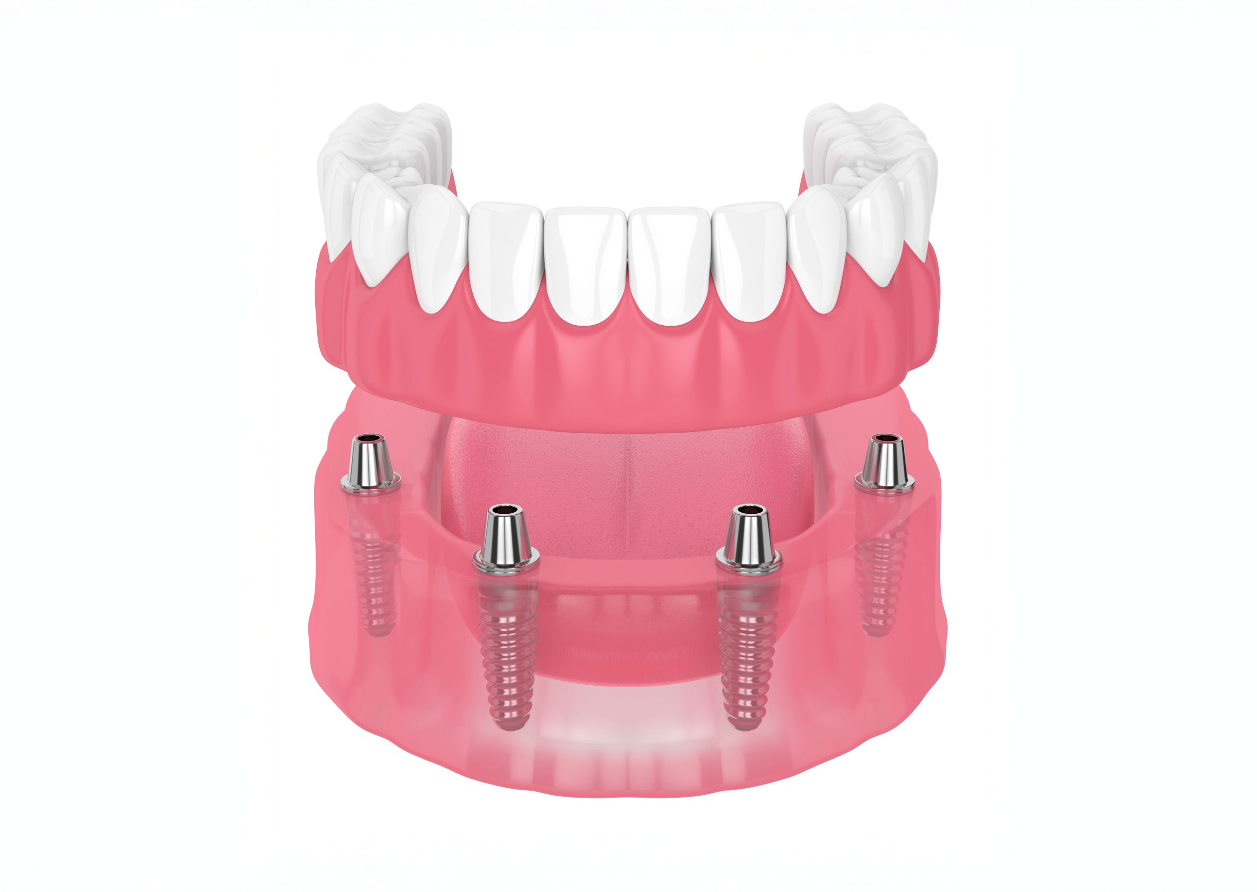 Dental Implants
