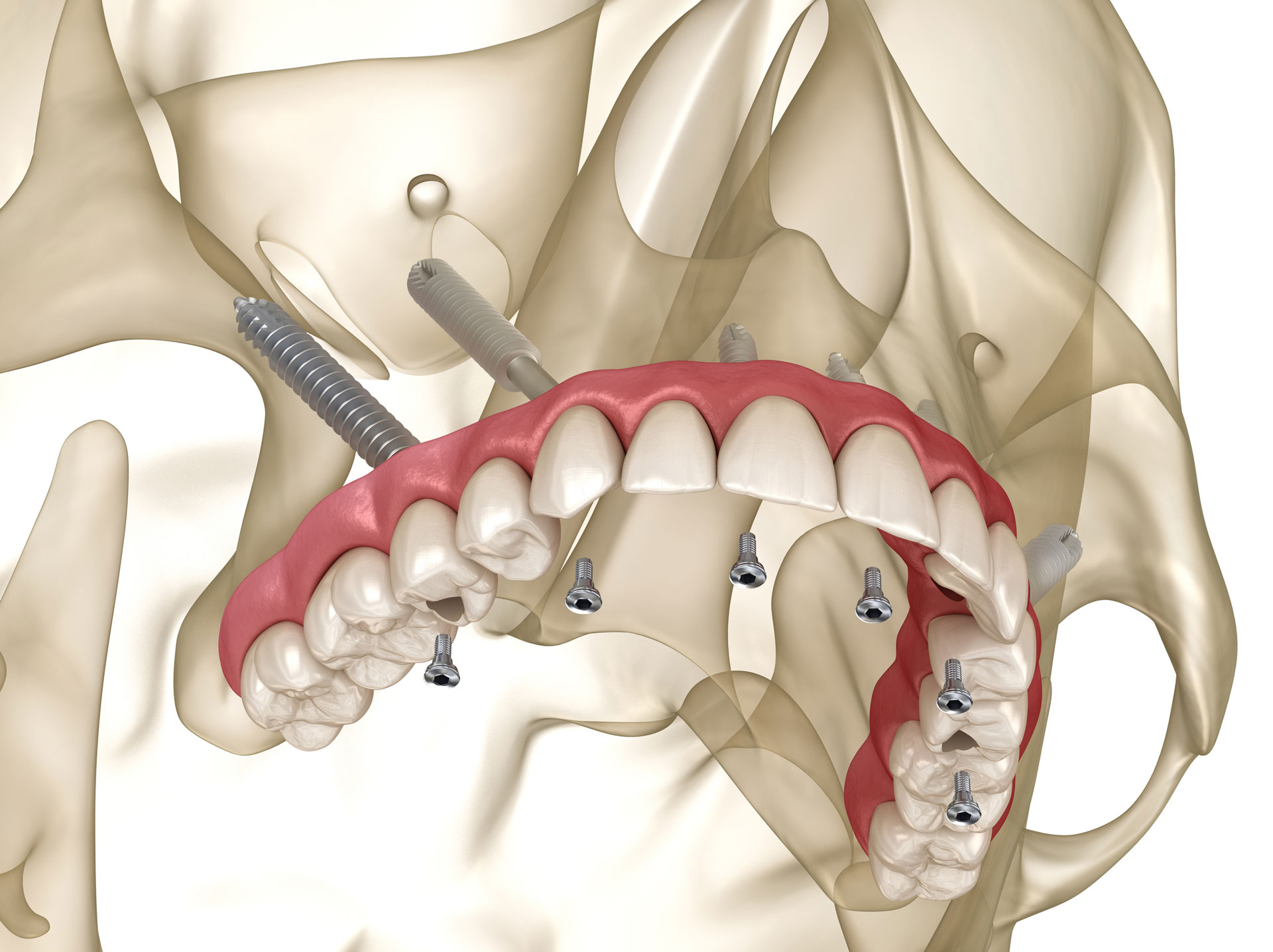 Dental Implants