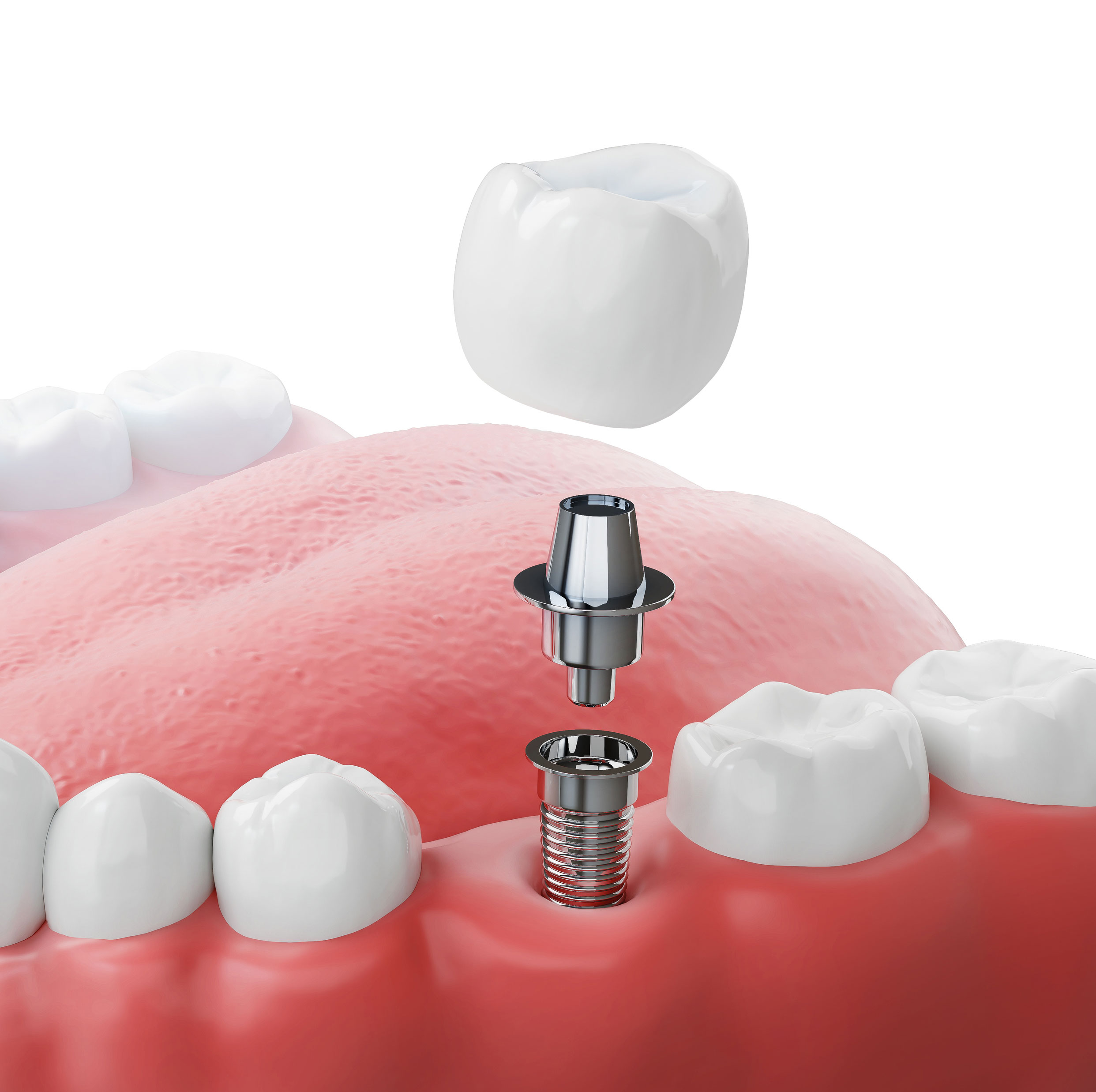 Dental Implants