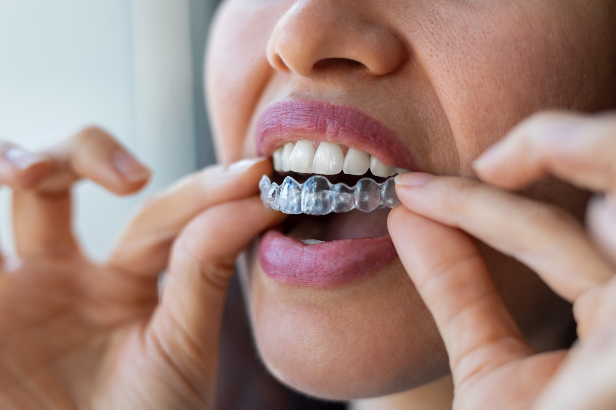 Invisalign Clear Aligners
