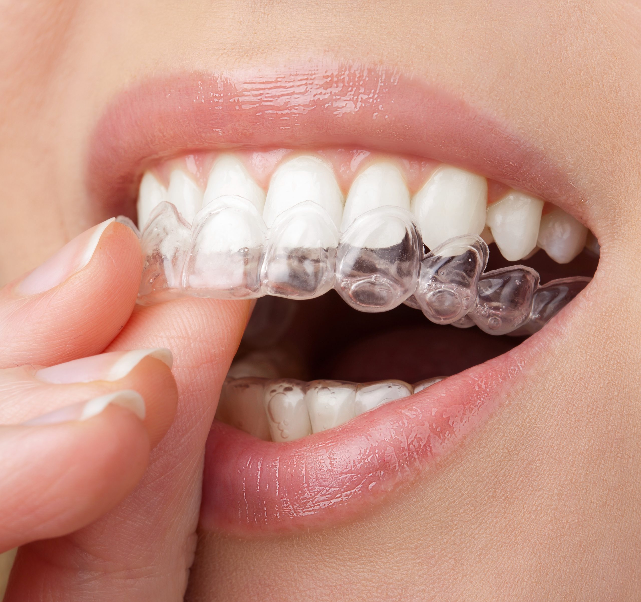 Invisalign Clear Aligners