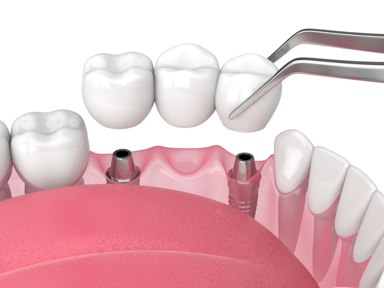 Dental Implants