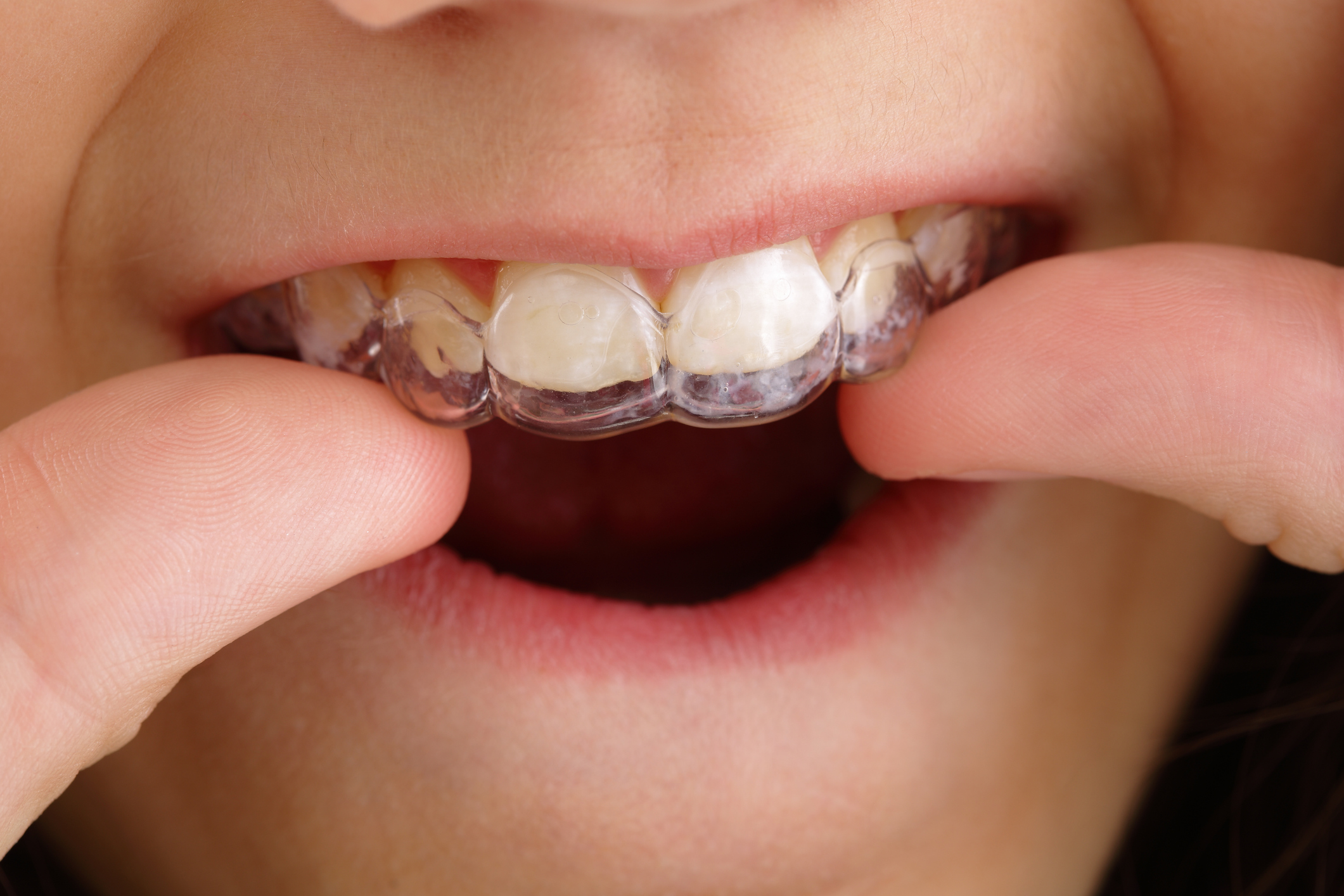 Invisalign Clear Aligners