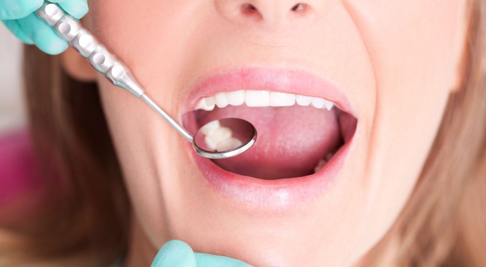 White Fillings