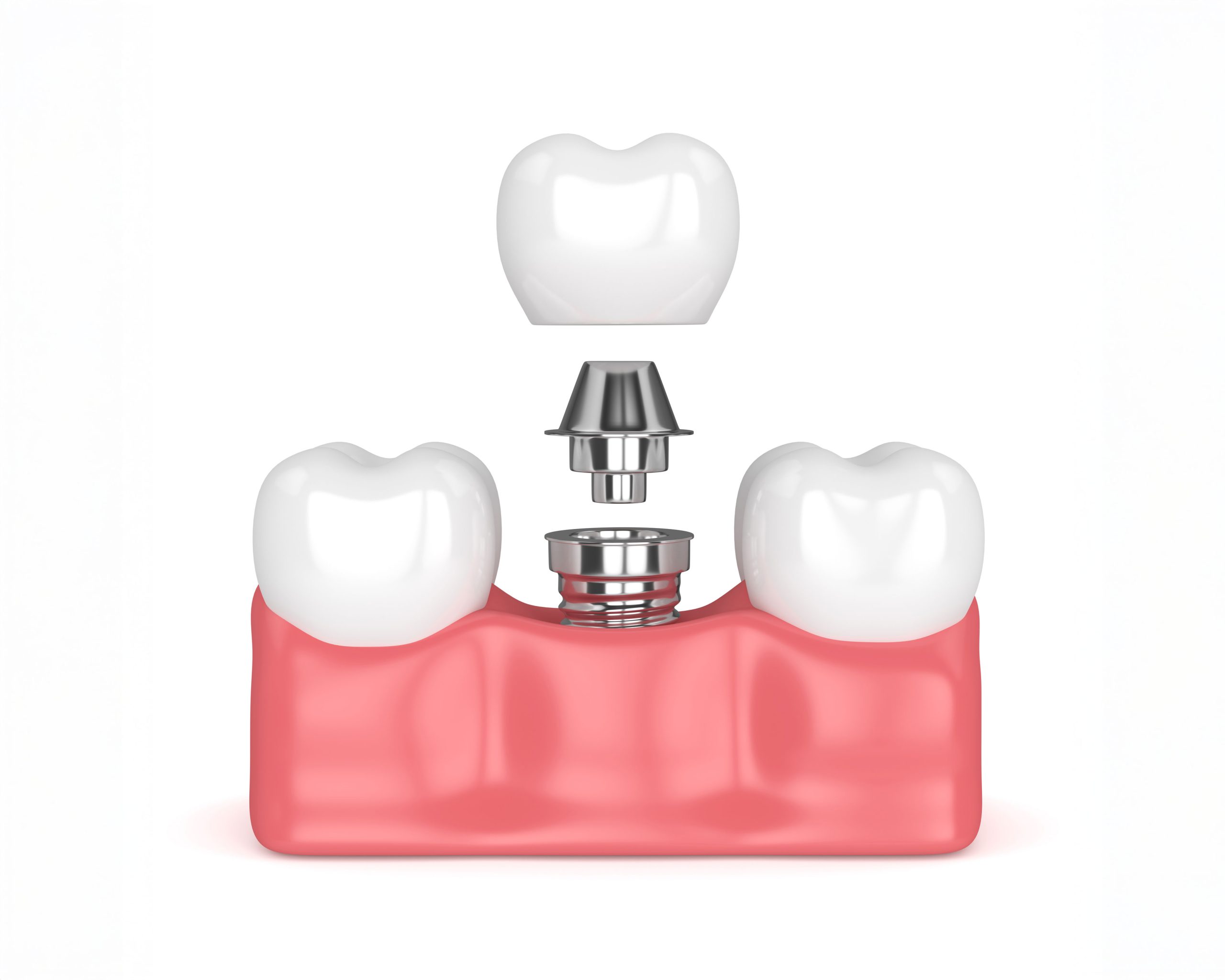 Dental Implants